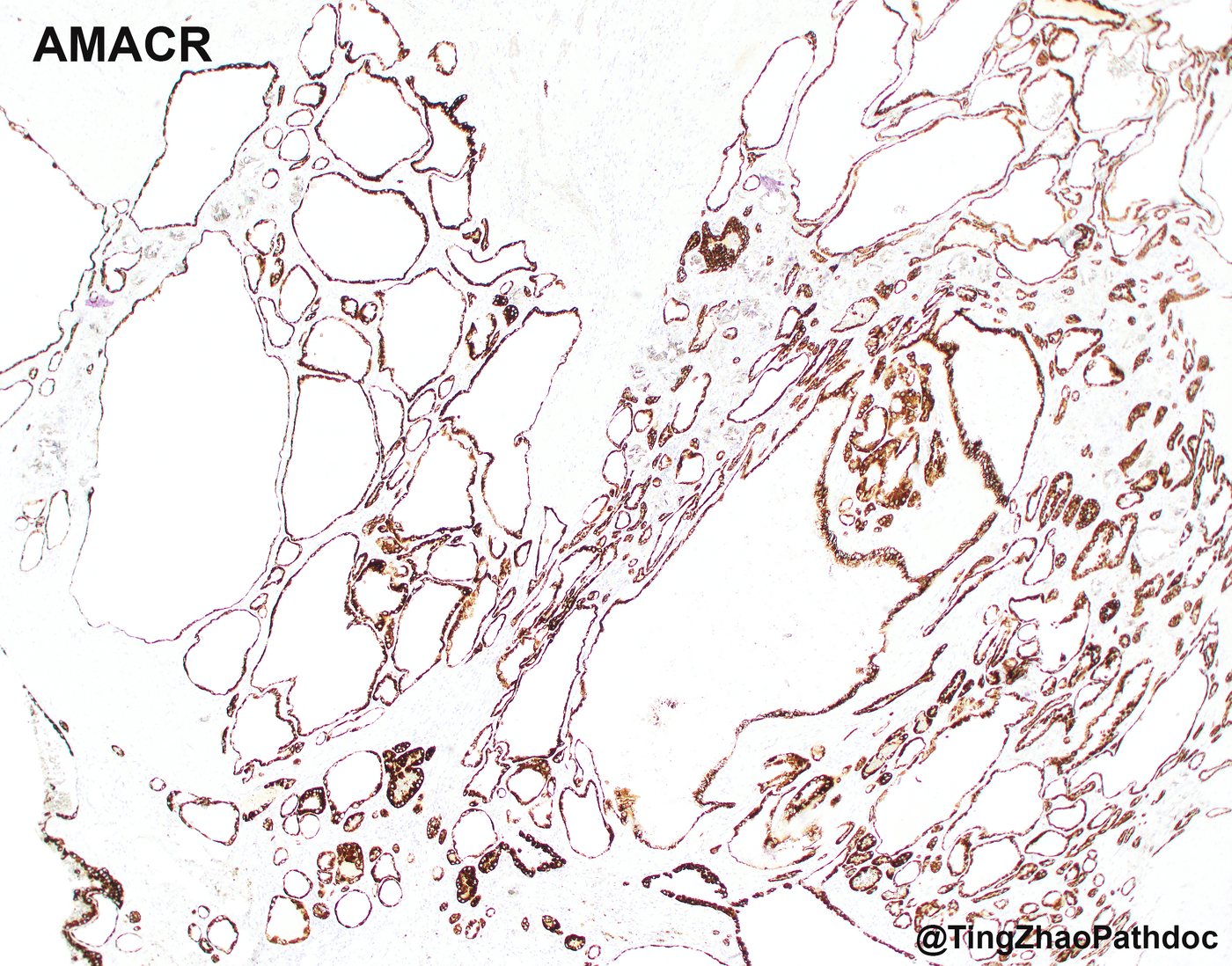 Acquired cystic disease-associated renal cell carcinoma — AMACR: strong, diffuse