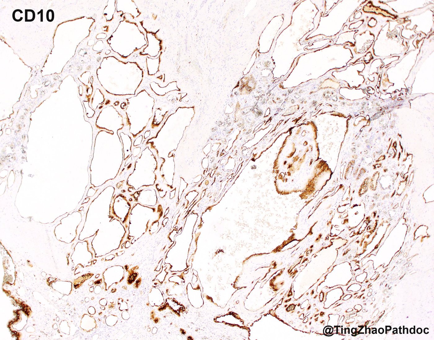 Acquired cystic disease-associated renal cell carcinoma — CD10: positive, luminal/membranous