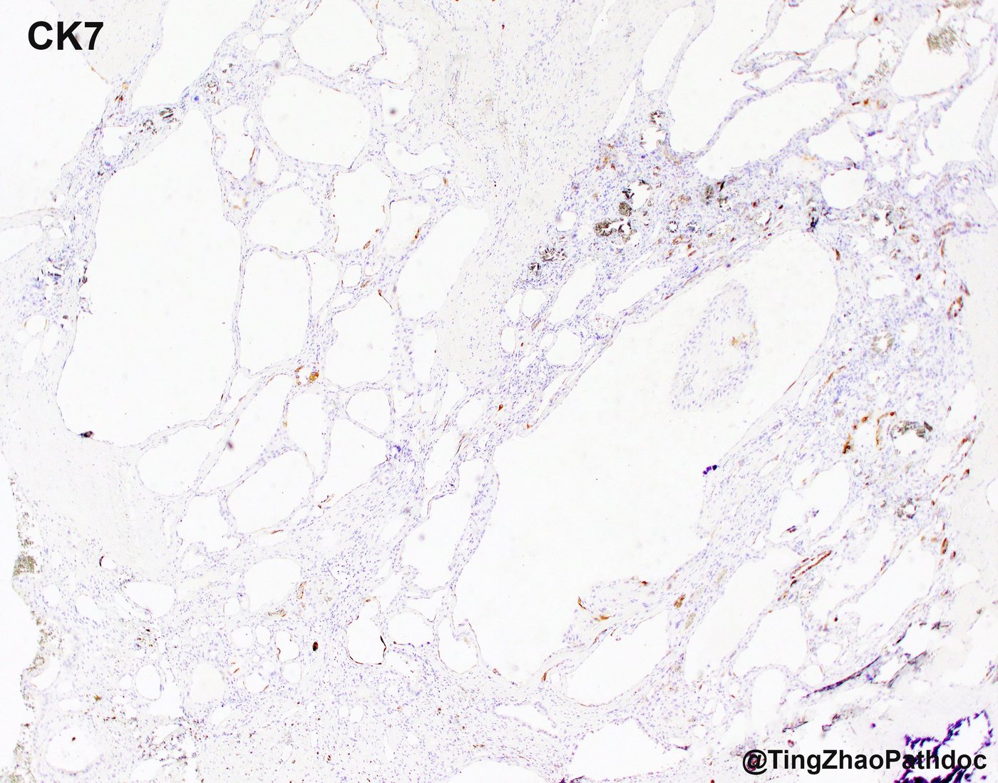 Acquired cystic disease-associated renal cell carcinoma — CK7: negative in tumour cells