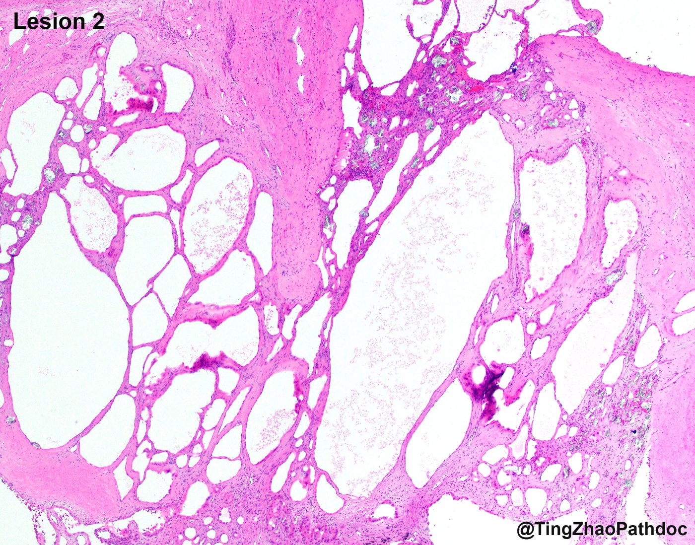 Acquired cystic disease-associated renal cell carcinoma — Lesion 2: multicystic architecture with sieve-like areas