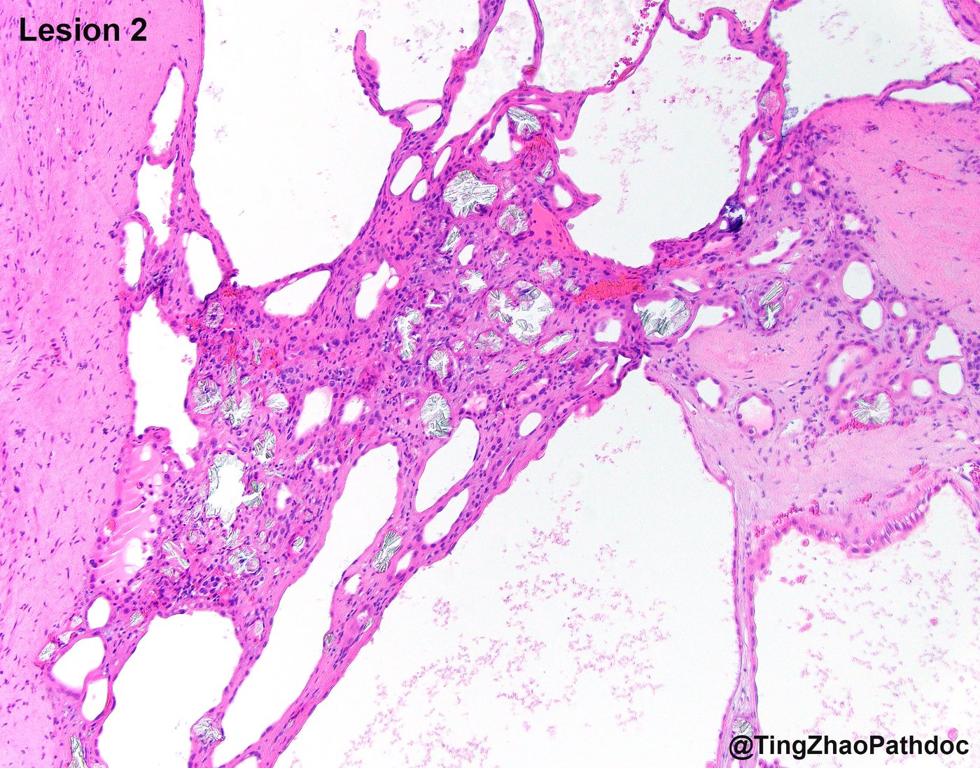 Acquired cystic disease-associated renal cell carcinoma — Lesion 2: eosinophilic cells with microlumina and calcium oxalate crystals