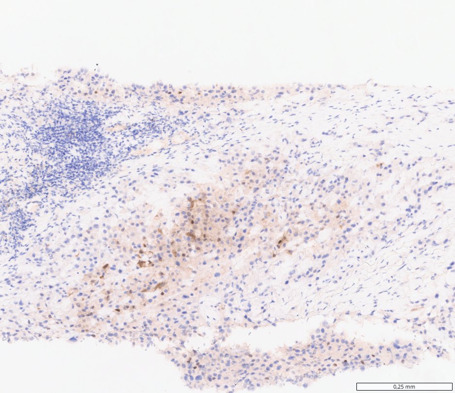 ALK-rearranged renal cell carcinomas: ALK: granular cytoplasmic staining in tumour cells