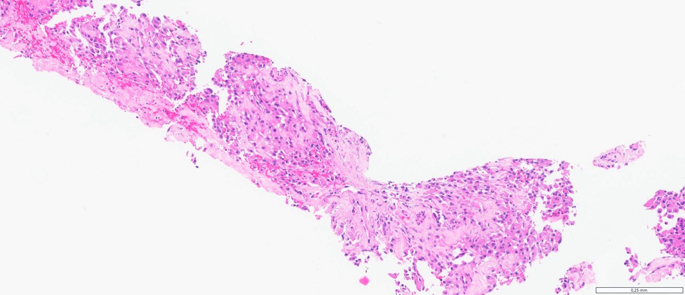 ALK-rearranged renal cell carcinomas: Discohesive eosinophilic cells in hyalinised stroma