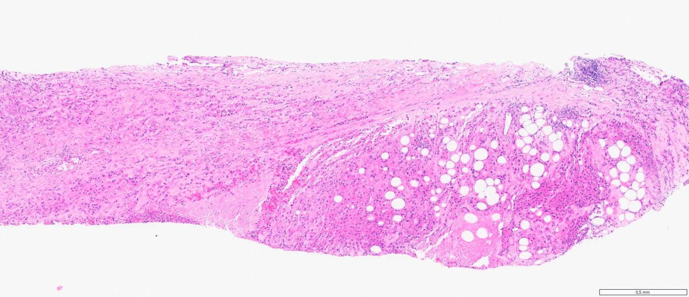 ALK-rearranged renal cell carcinomas: Core biopsy: eosinophilic tumour with numerous clear vacuoles beside fibrotic stroma