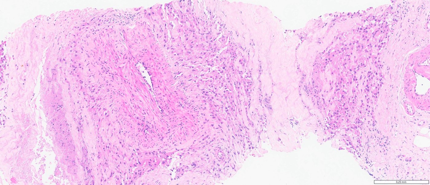 ALK-rearranged renal cell carcinomas: Epithelioid and spindled cells in fibrous and myxoid stroma
