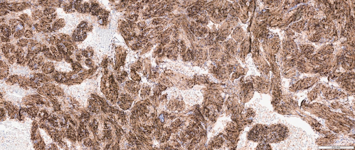 Classic angiomyolipoma / PEComa of the kidney: Cathepsin K: diffuse cytoplasmic staining