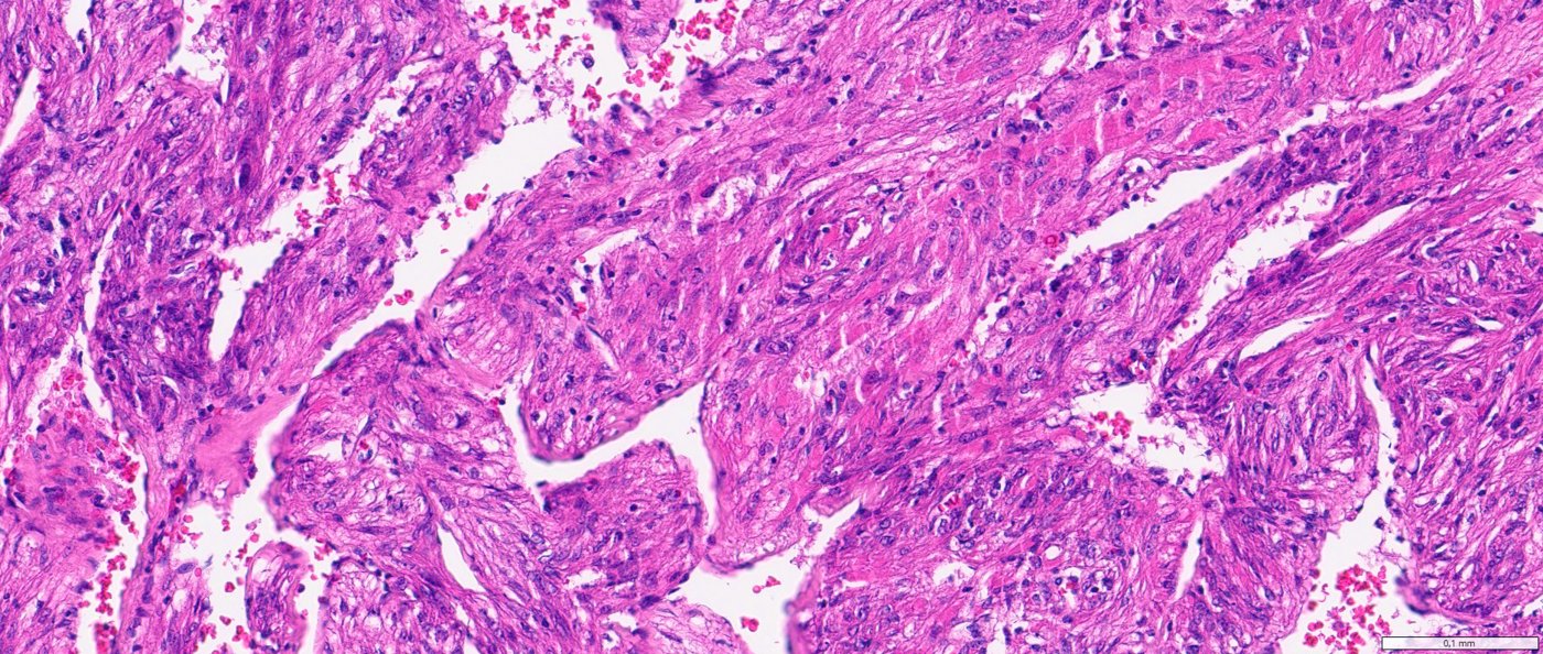 Classic angiomyolipoma / PEComa of the kidney: Fat-poor AML, high power: bland myoid cells