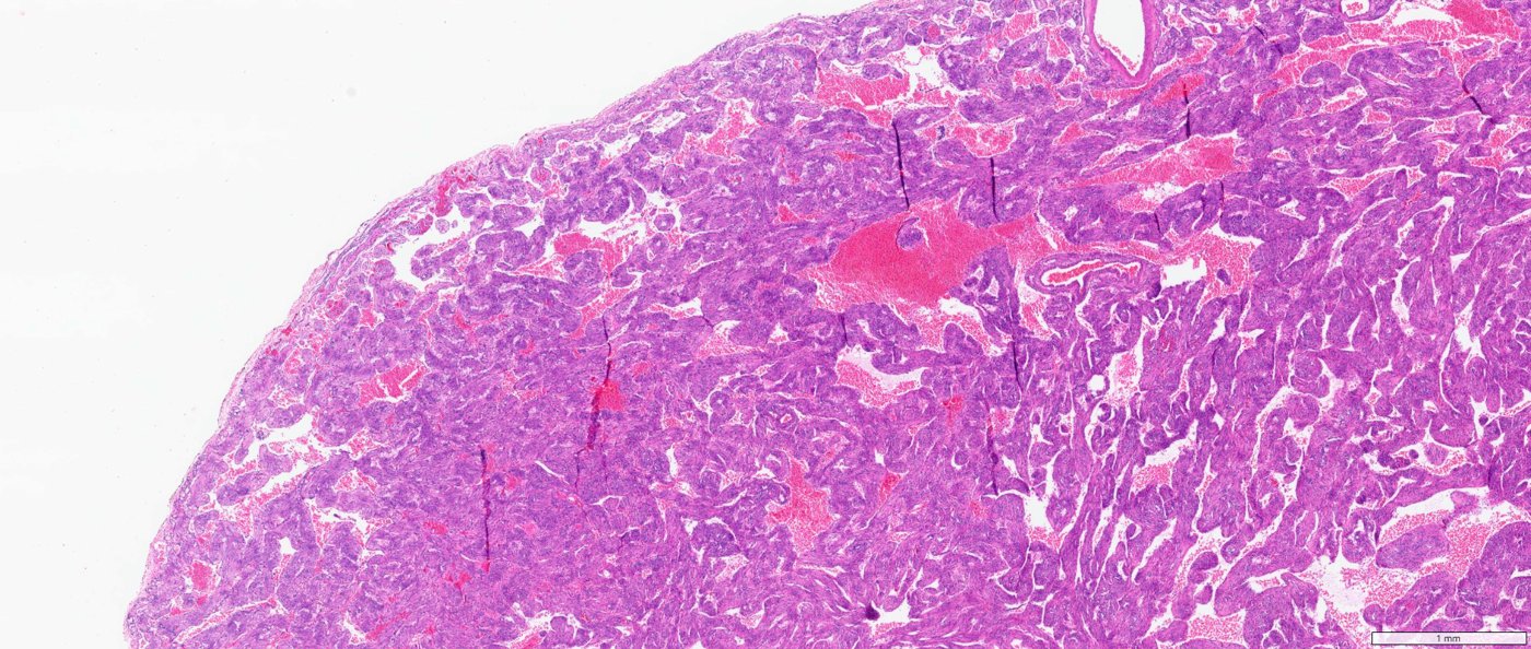 Classic angiomyolipoma / PEComa of the kidney: Fat-poor AML, low power: solid myoid tumour with blood-filled spaces