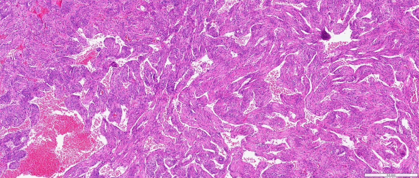 Classic angiomyolipoma / PEComa of the kidney: Fat-poor AML: papilla-like (pseudopapillary) architecture