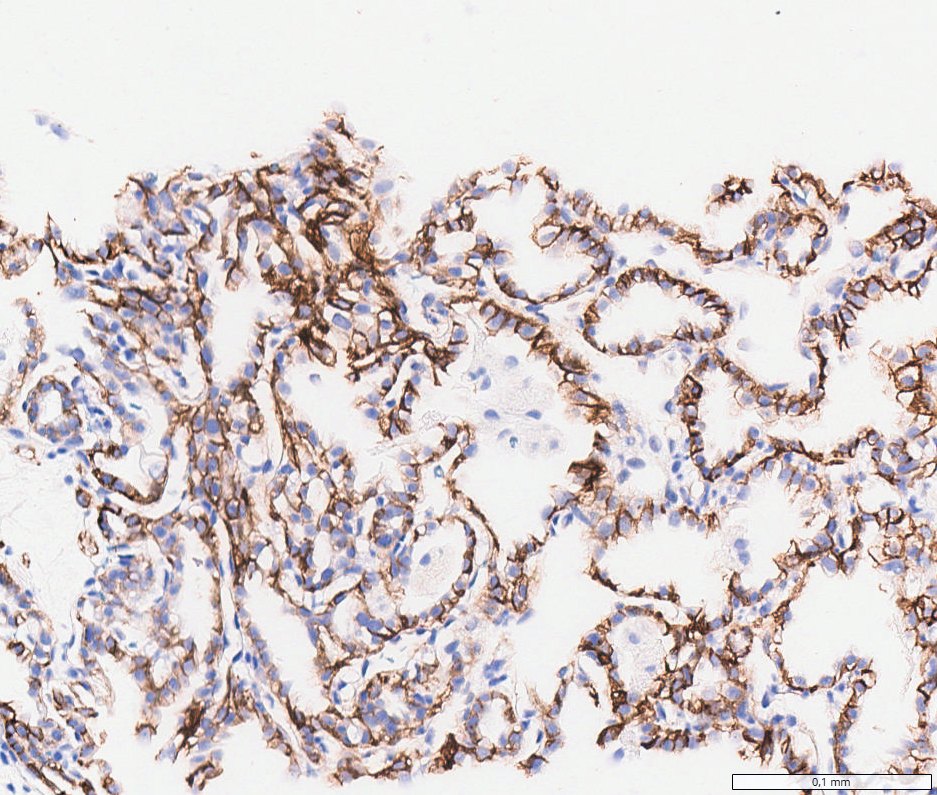 Clear cell papillary renal cell tumour: CA9 (CAIX): basolateral cup-like membranous staining