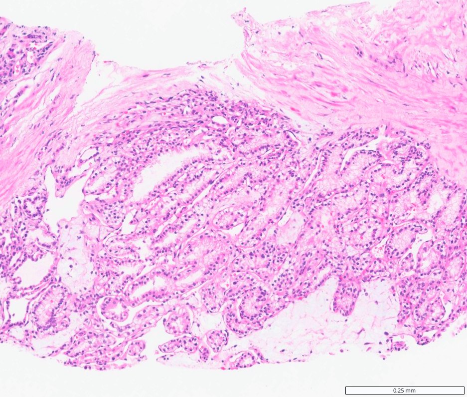 Clear cell papillary renal cell tumour: Branching tubules of clear cells in fibrous stroma (core biopsy)