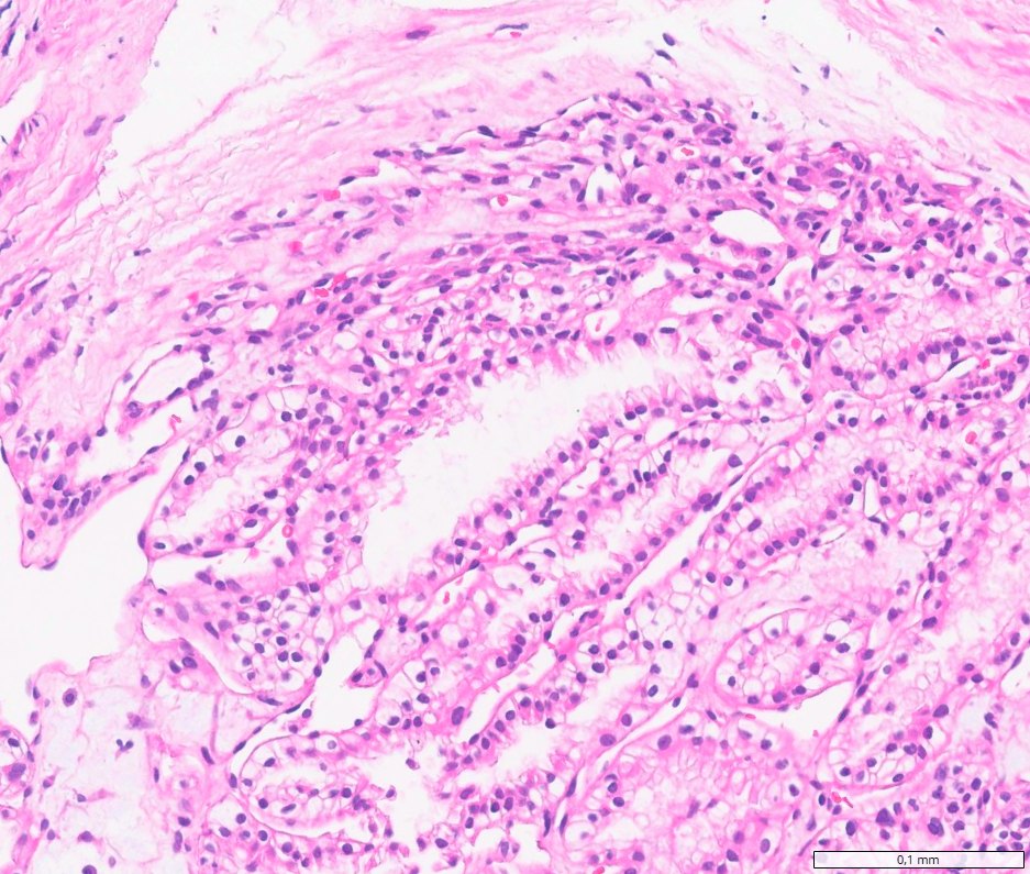 Clear cell papillary renal cell tumour: Tubules of low-grade clear cells with nuclei aligned away from the basement membrane