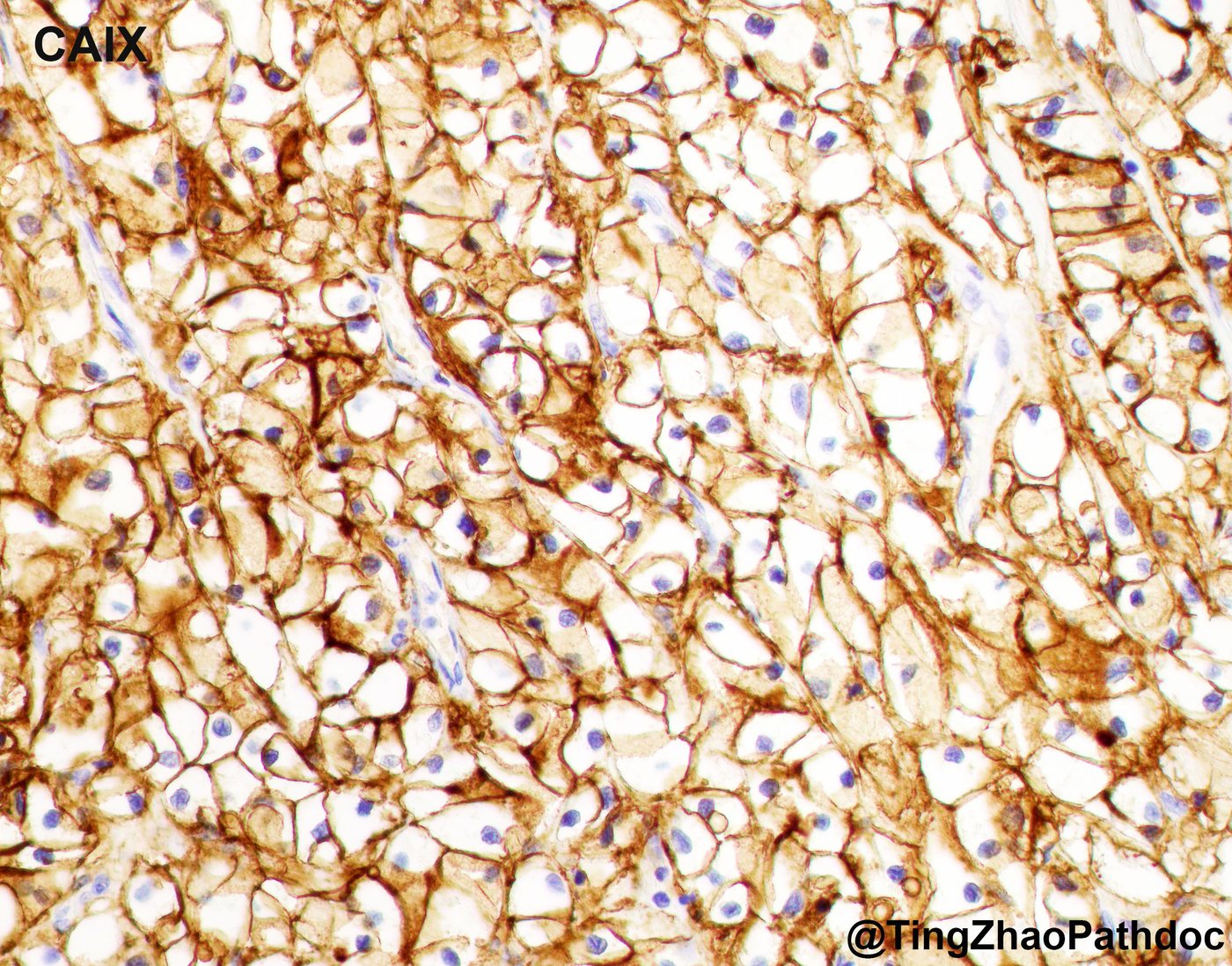 Clear cell renal cell carcinoma — CAIX: diffuse, complete membranous (box-like)
