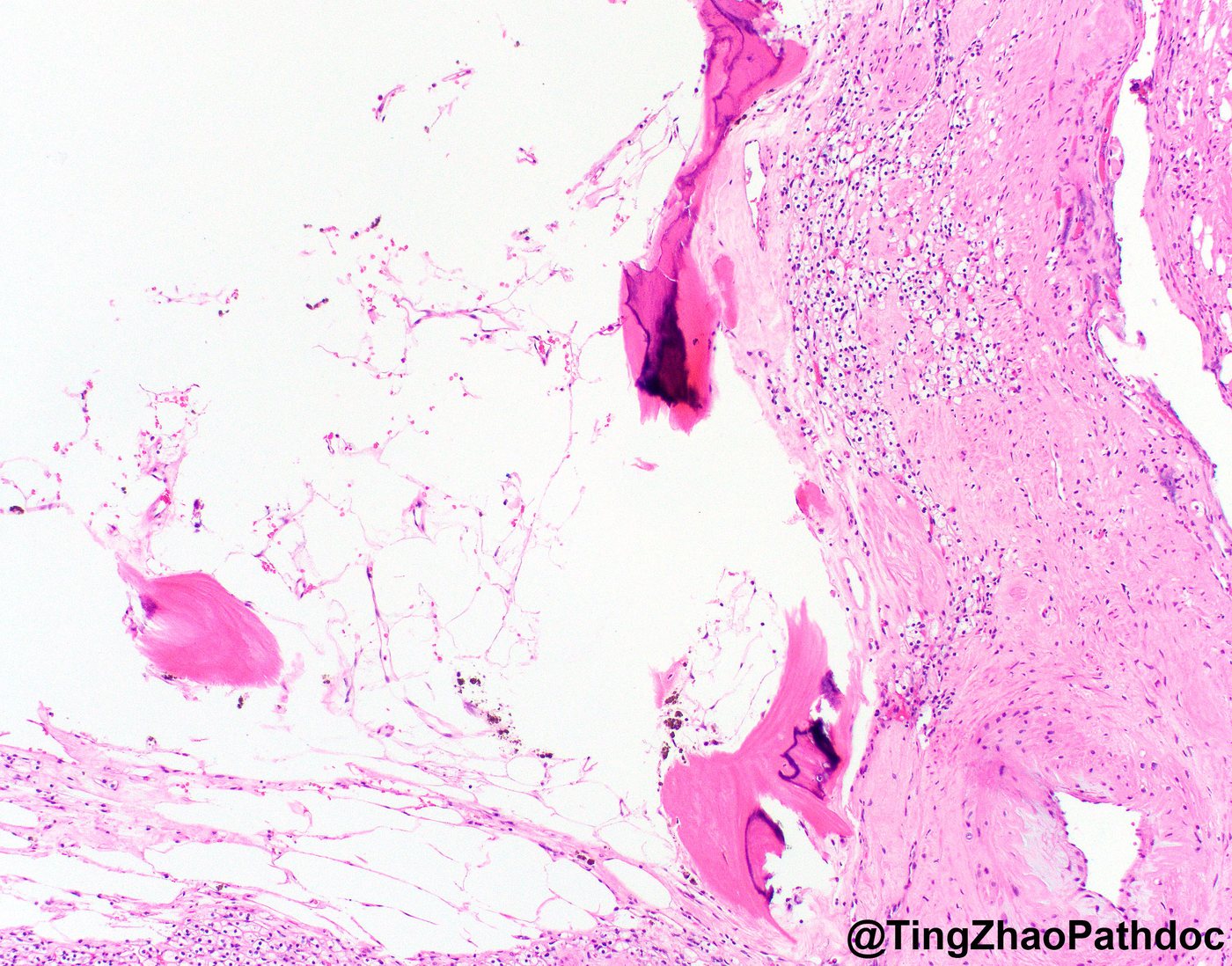 Clear cell renal cell carcinoma — Stromal hyalinisation and dystrophic calcification