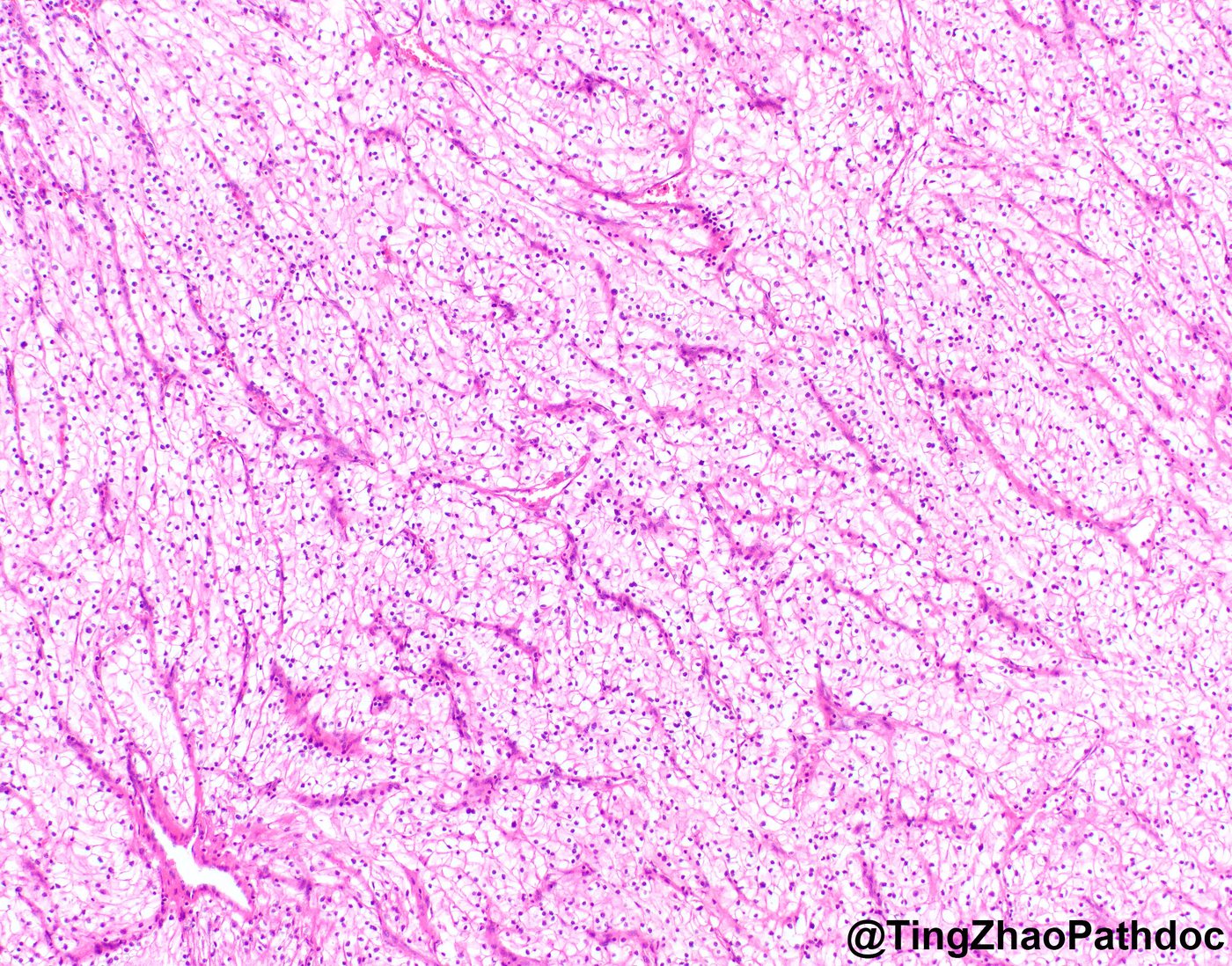 Clear cell renal cell carcinoma — Classic nested pattern with delicate capillary network