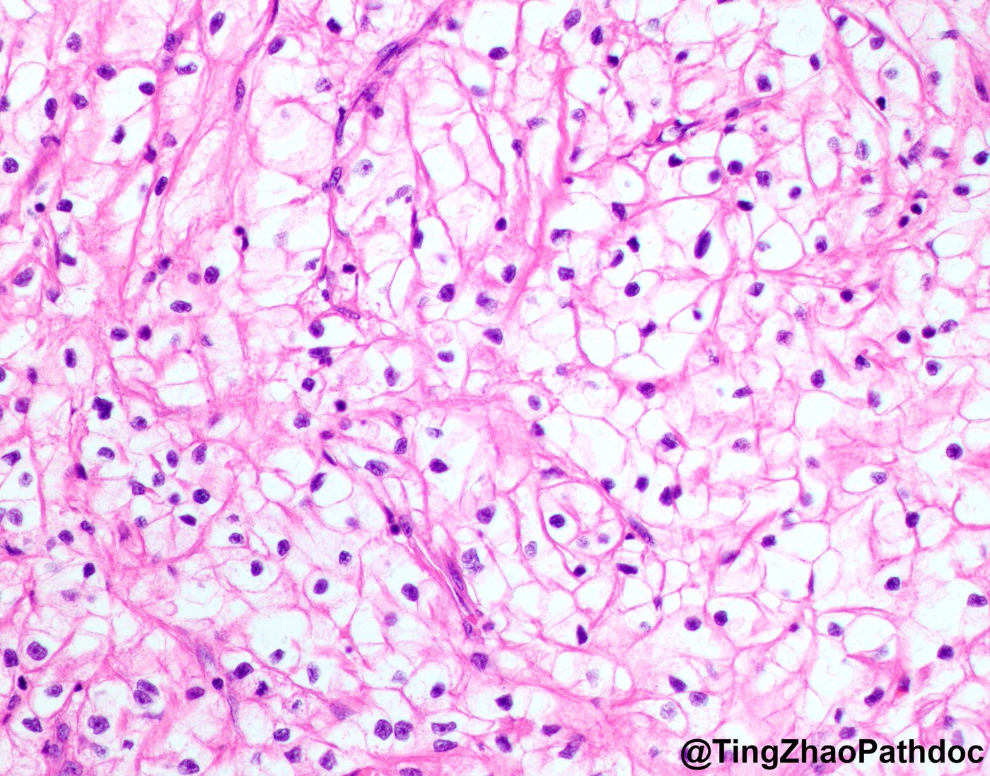 Clear cell renal cell carcinoma — Low-grade clear cells with distinct membranes
