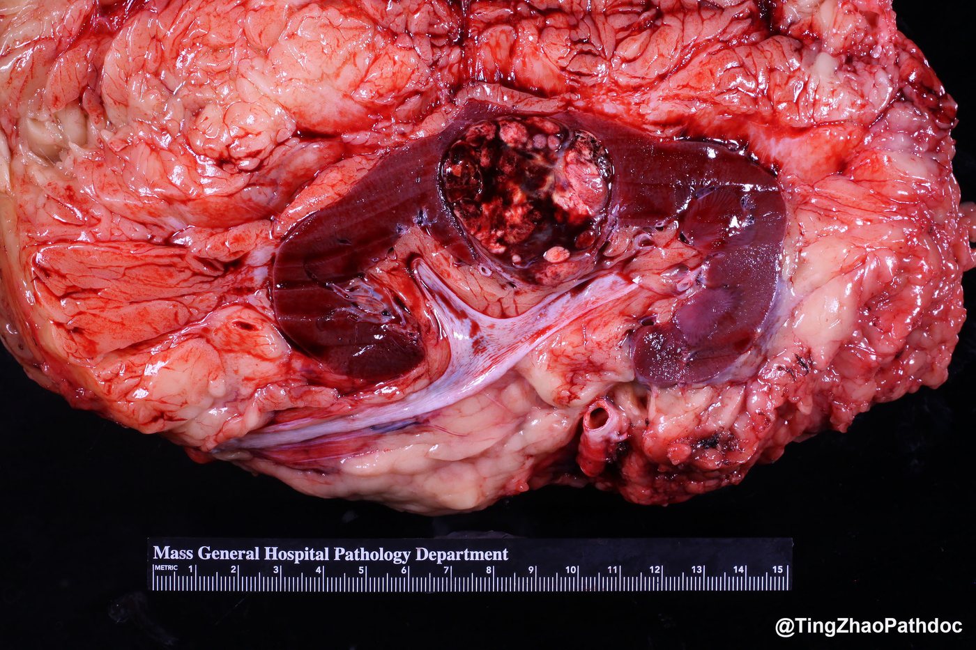 Clear cell renal cell carcinoma — Gross: variegated, haemorrhagic renal mass