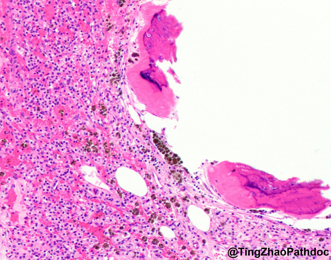 Clear cell renal cell carcinoma — Haemorrhage and haemosiderin deposition