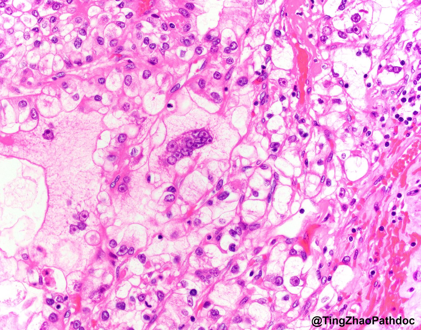 Clear cell renal cell carcinoma — High-grade cytology with tumour giant cells