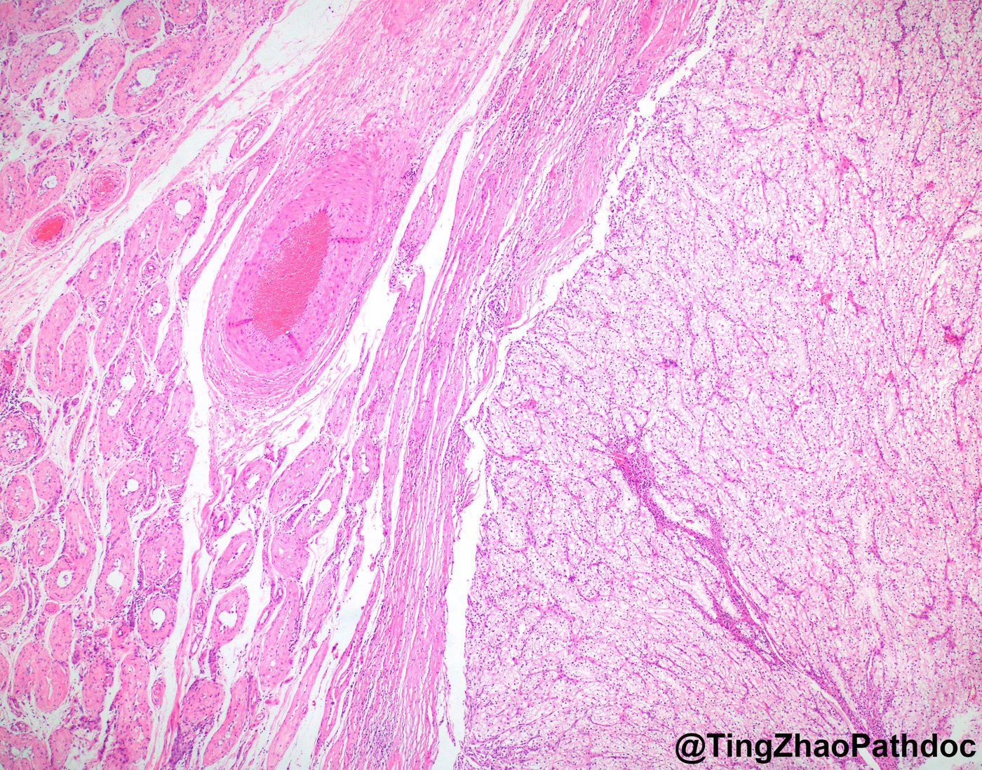 Clear cell renal cell carcinoma — Tumour interface at low power
