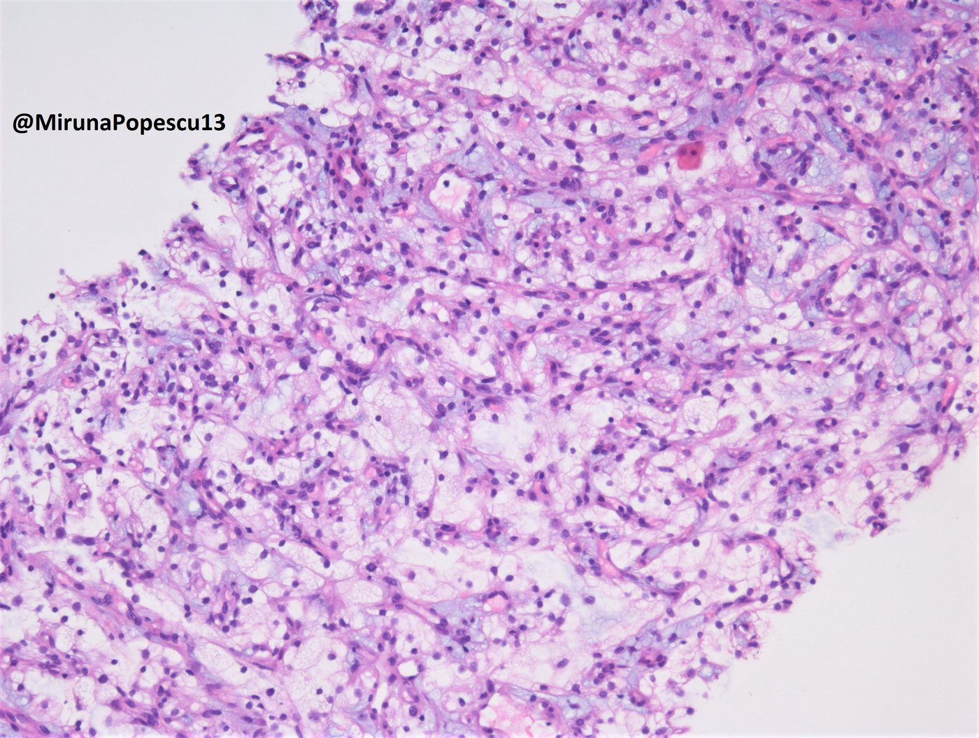 Clear cell renal cell carcinoma — ccRCC on needle core biopsy