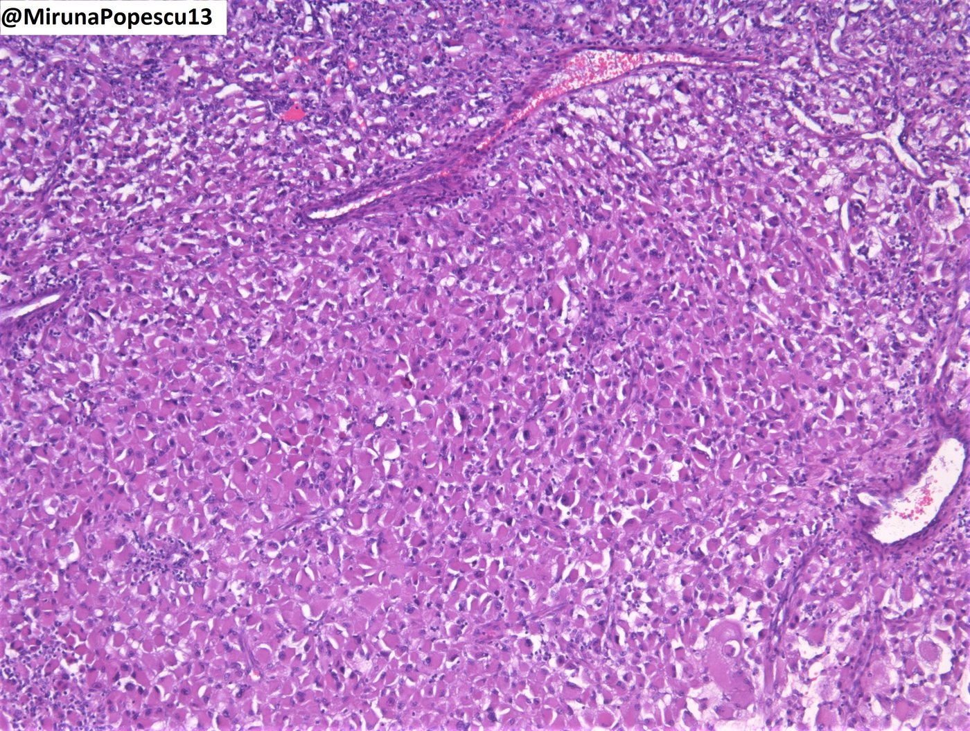 Clear cell renal cell carcinoma — Eosinophilic (granular) cytoplasm