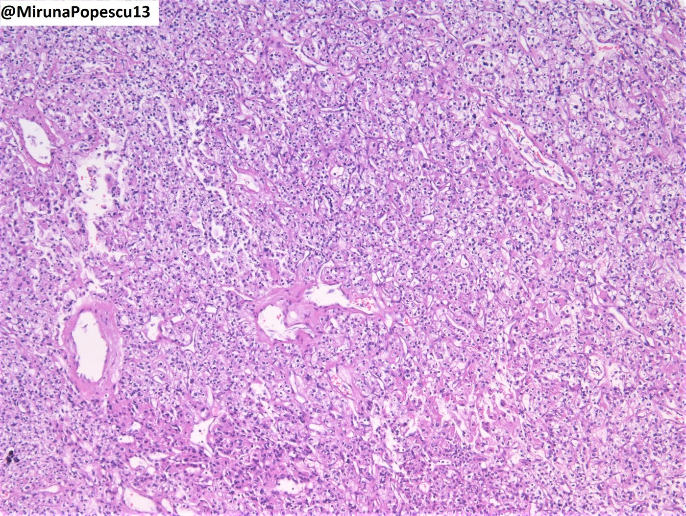Clear cell renal cell carcinoma — Low power: solid-nested growth with branching vessels