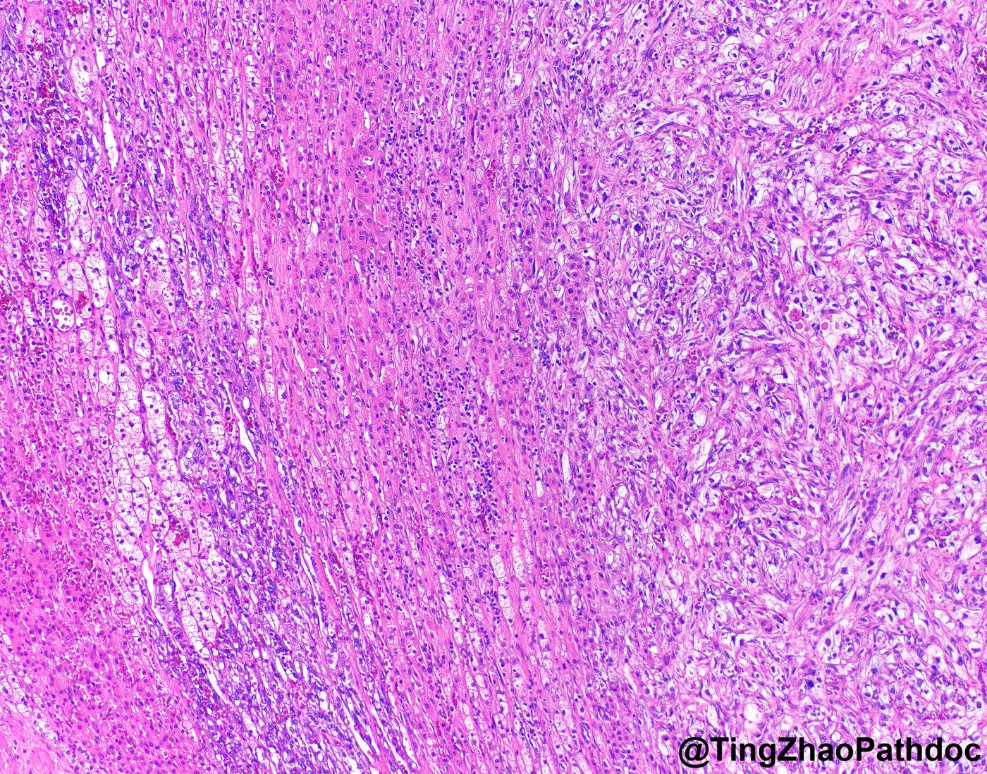 Clear cell renal cell carcinoma — Transition to a spindle (sarcomatoid) component