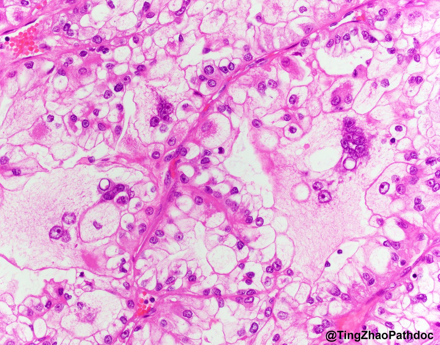 Clear cell renal cell carcinoma — Multinucleated syncytial-type giant cells