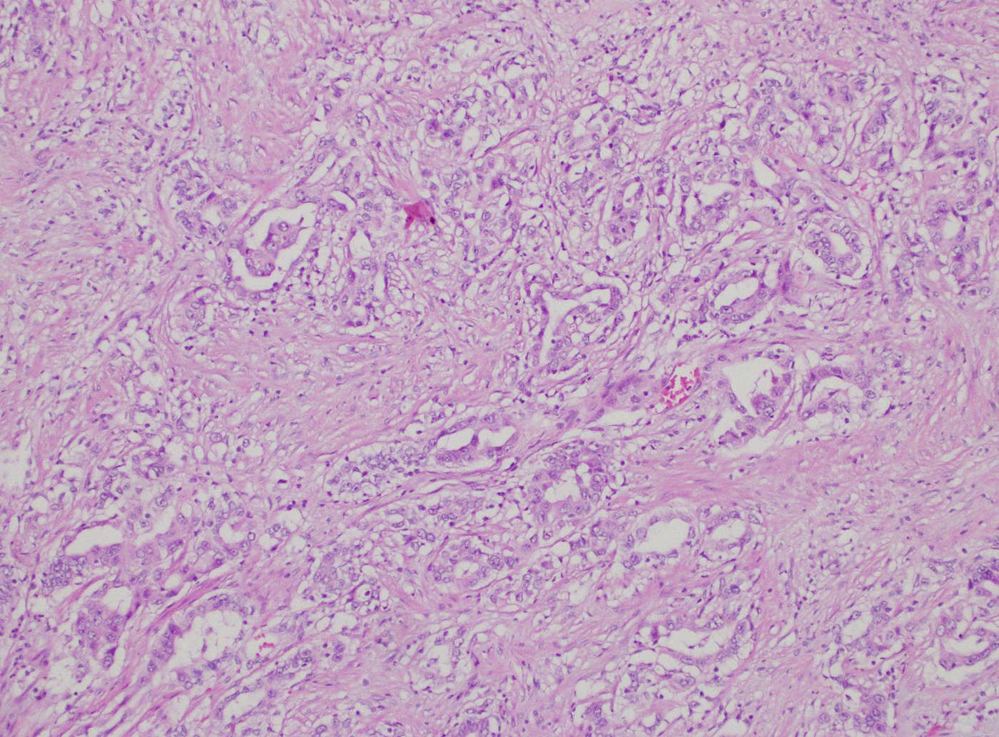 Collecting duct carcinoma: High-grade angulated glands in desmoplastic stroma