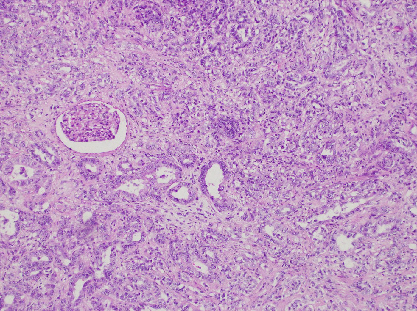Collecting duct carcinoma: Irregular infiltrative tubules and glands with an entrapped glomerulus