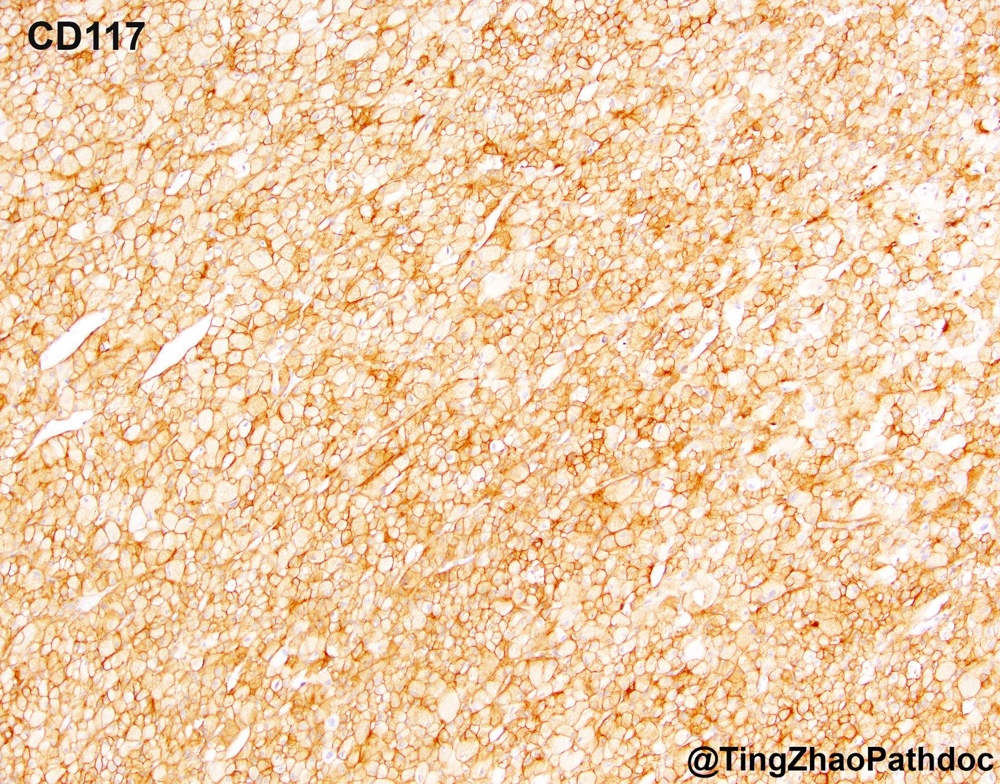 Chromophobe renal cell carcinoma — CD117: diffuse membranous