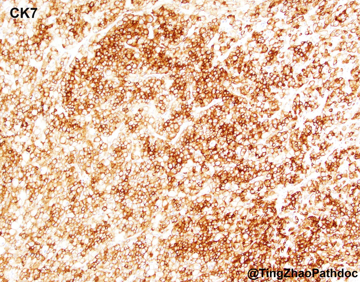 Chromophobe renal cell carcinoma — CK7: strong, diffuse