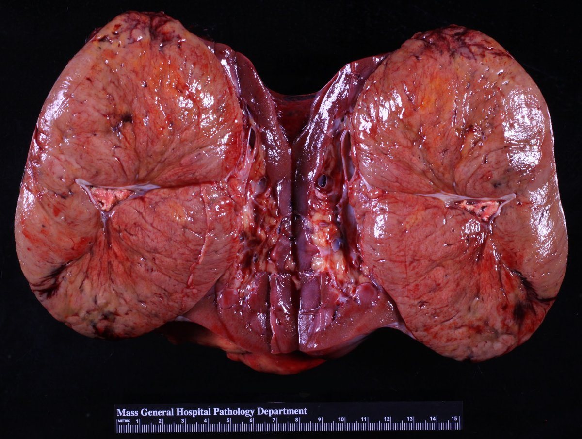 Chromophobe renal cell carcinoma — Gross: large, solid, homogeneous tan-beige tumour