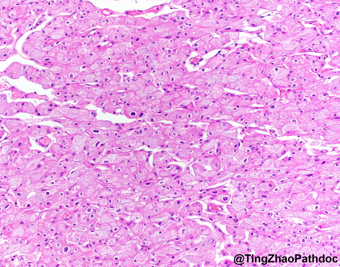 Chromophobe renal cell carcinoma — Plant-like cells with crisp borders, pale reticular cytoplasm and wrinkled nuclei
