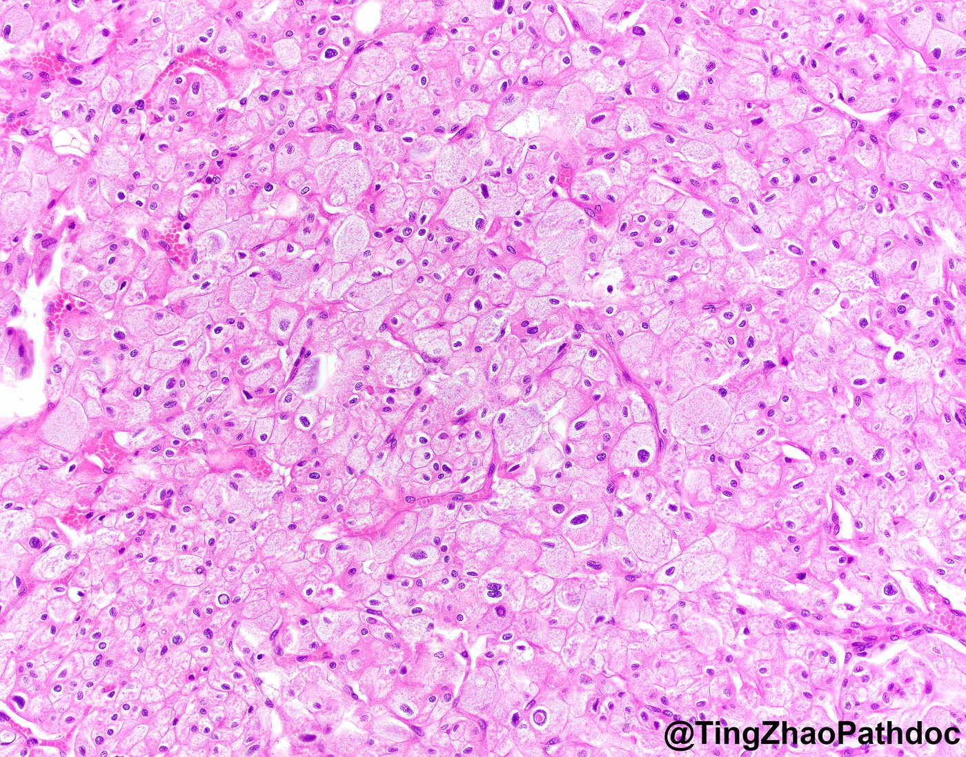 Chromophobe renal cell carcinoma — Perinuclear halos, binucleation and raisinoid nuclei