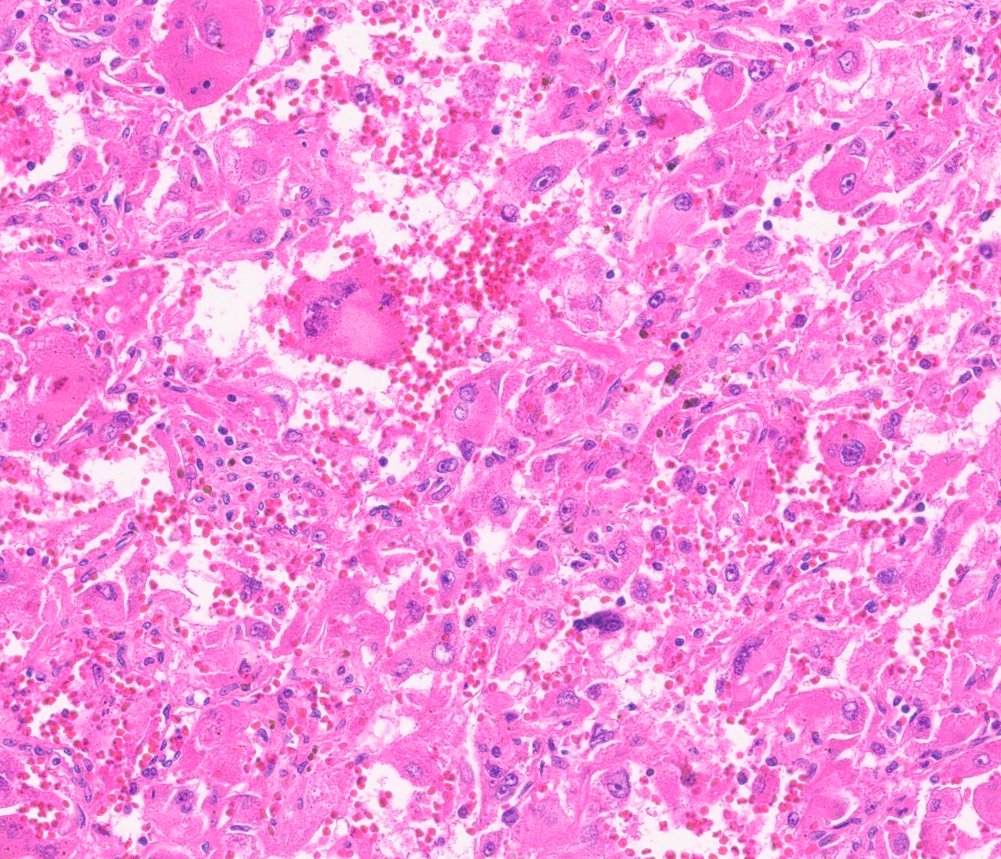Epithelioid angiomyolipoma / epithelioid PEComa of the kidney: Epithelioid AML, high power: pleomorphic and multinucleated cells
