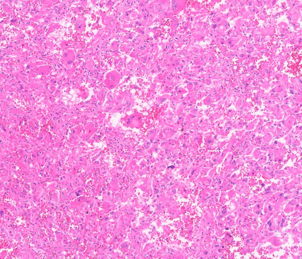 Epithelioid angiomyolipoma / epithelioid PEComa of the kidney: Epithelioid AML: discohesive sheets of polygonal cells with haemorrhage