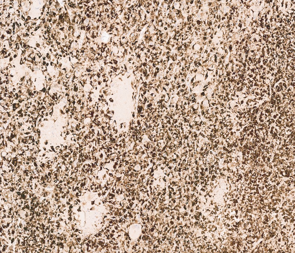 Epithelioid angiomyolipoma / epithelioid PEComa of the kidney: HMB45: diffuse strong staining