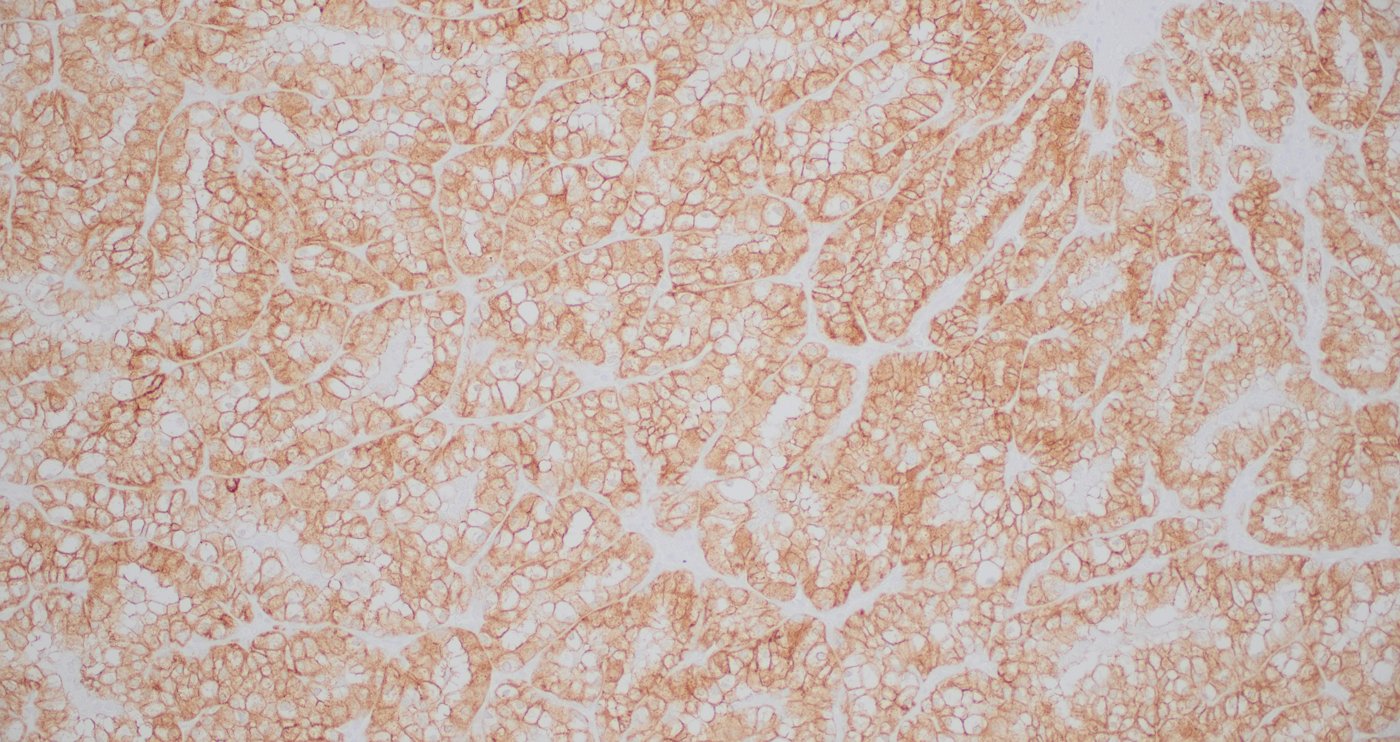 ELOC (formerly TCEB1)-mutated renal cell carcinoma: CA9 (CAIX): diffuse complete membranous (box-like) staining