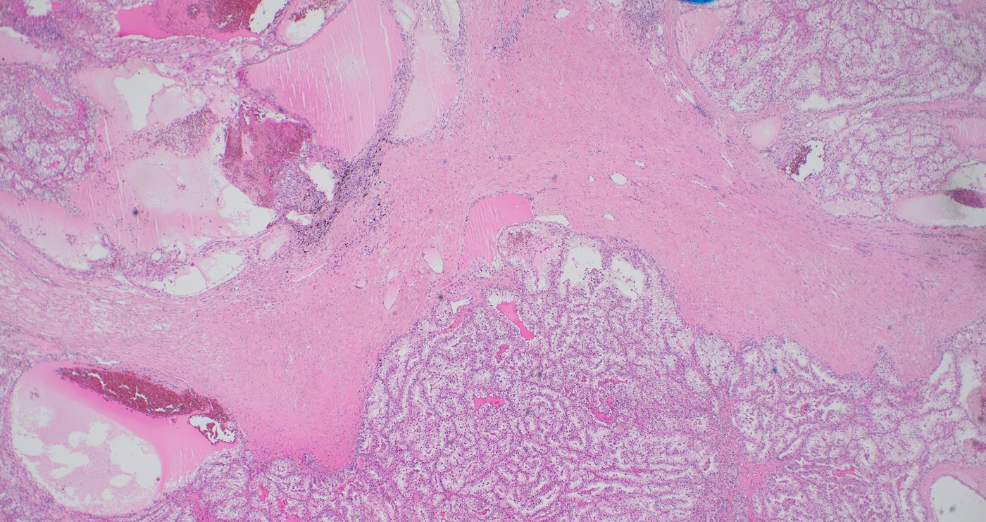 ELOC (formerly TCEB1)-mutated renal cell carcinoma: Low power: multinodular tumour divided by broad fibromuscular septa