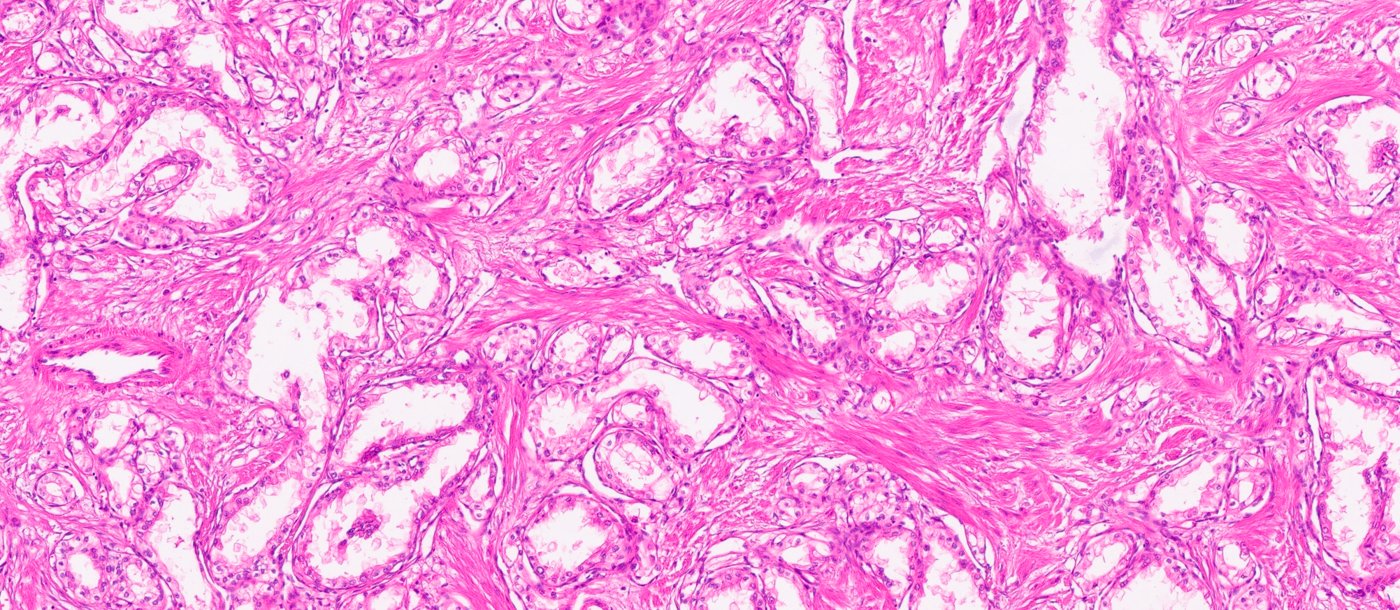 ELOC (formerly TCEB1)-mutated renal cell carcinoma: Branching tubules and acini of clear cells within fibromuscular stroma
