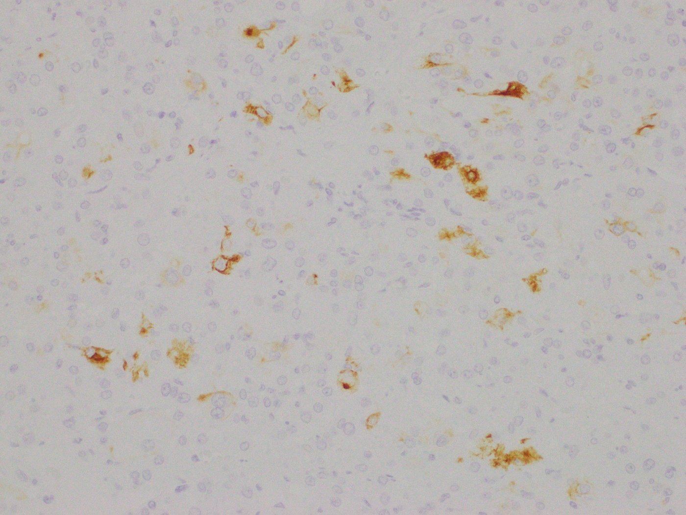Eosinophilic solid and cystic renal cell carcinoma: CK20: patchy positivity in scattered tumour cells