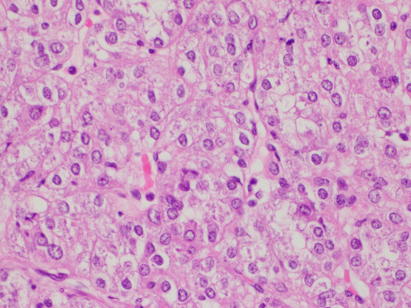 Eosinophilic solid and cystic renal cell carcinoma: High power: abundant eosinophilic cytoplasm with coarse stippling and round nuclei