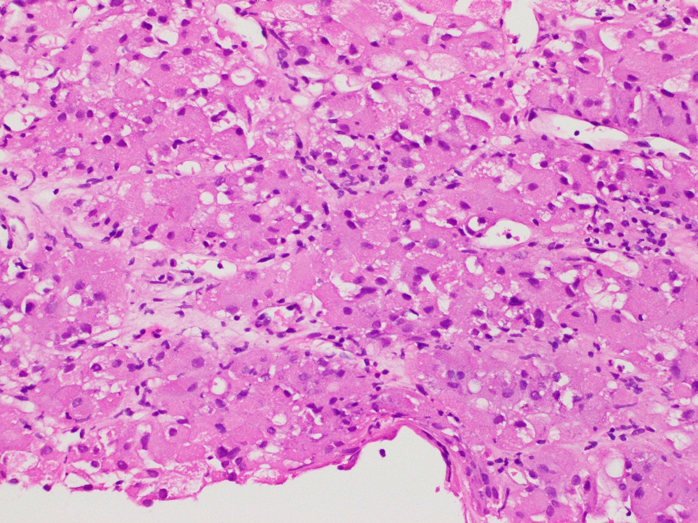 Eosinophilic solid and cystic renal cell carcinoma: Large eosinophilic cells with flocculent, vacuolated cytoplasm; cyst wall at the edge