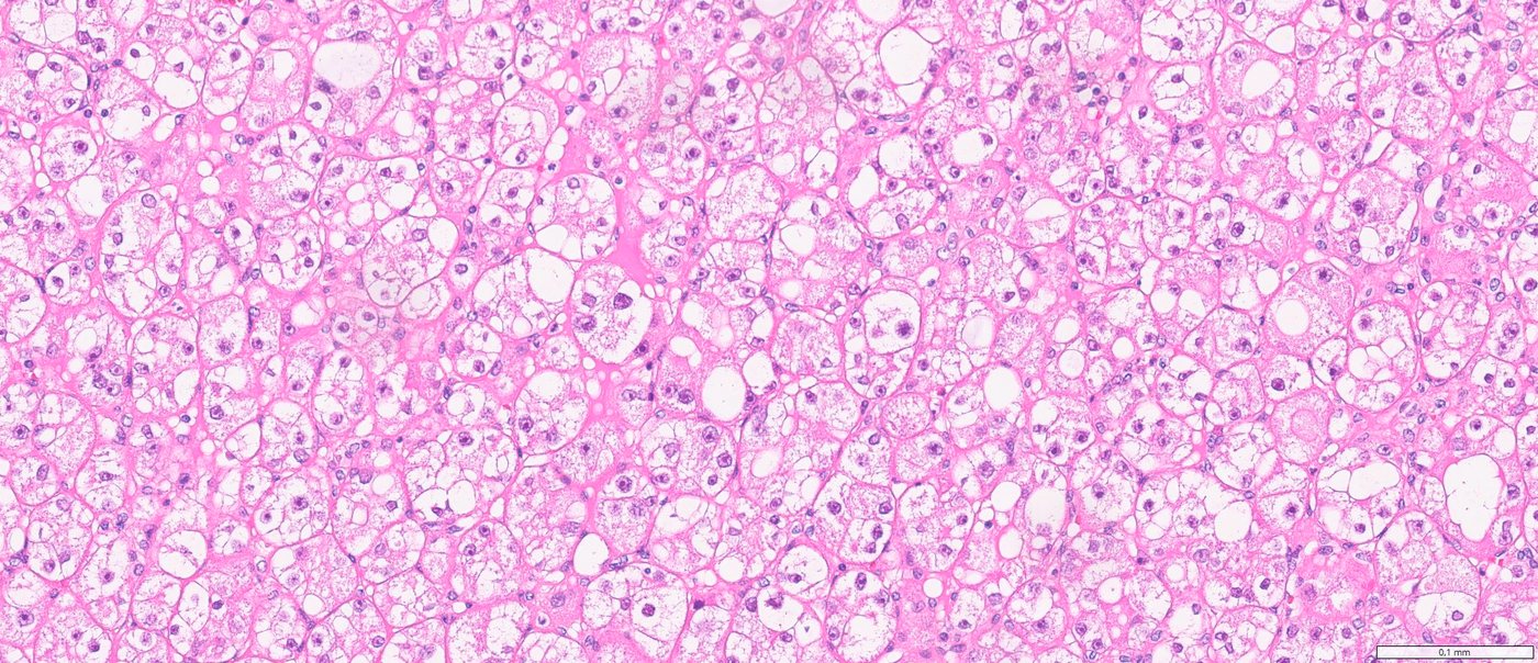Eosinophilic vacuolated tumour: Large intracytoplasmic vacuoles and prominent nucleoli