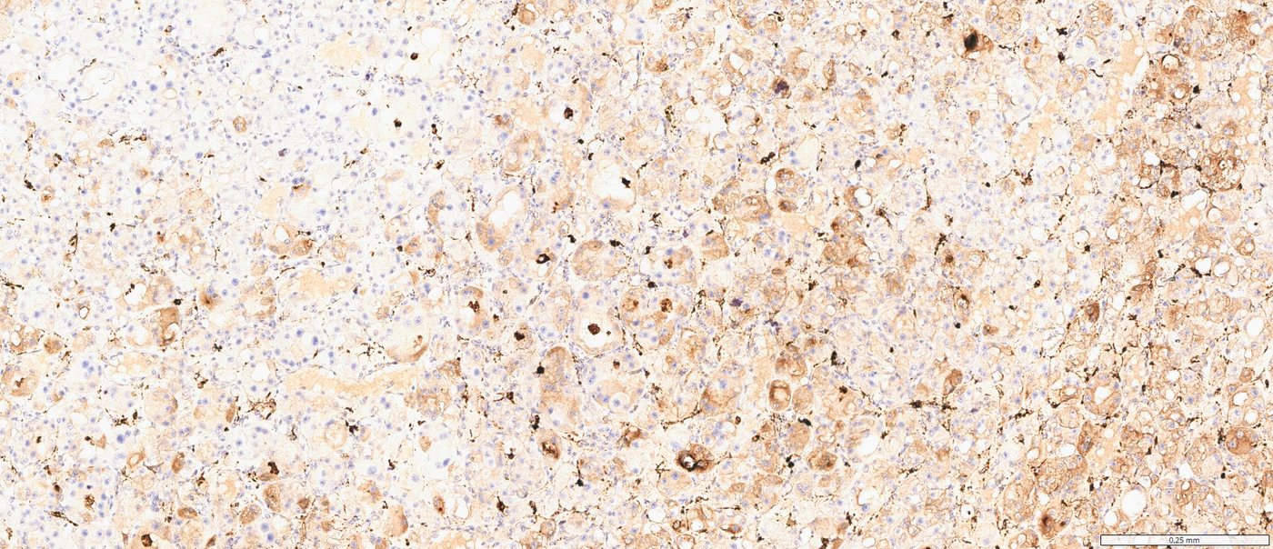 Eosinophilic vacuolated tumour: Cathepsin K: granular cytoplasmic