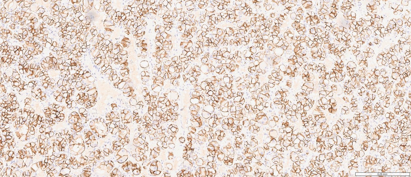 Eosinophilic vacuolated tumour: CD56: membranous