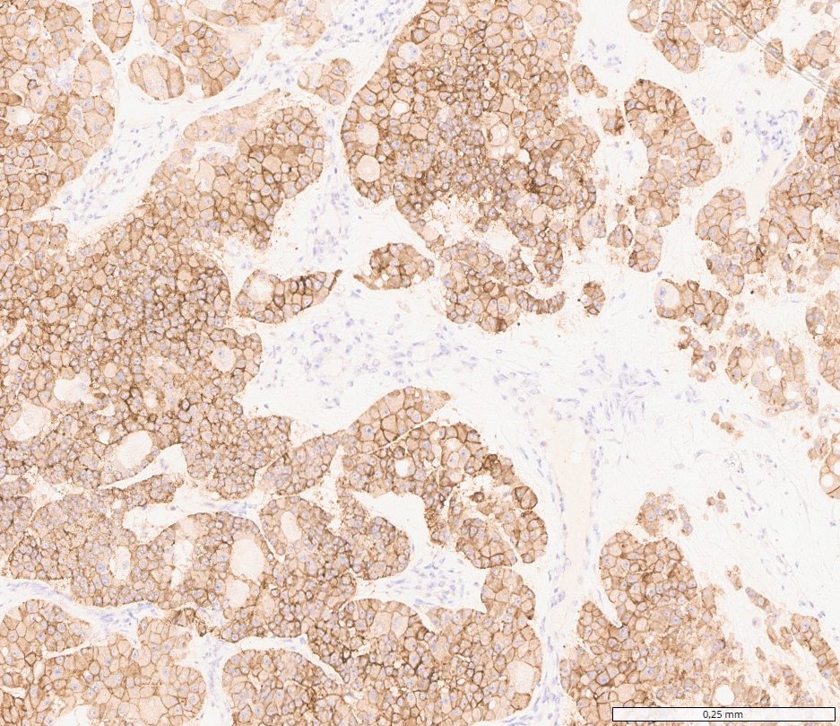 Eosinophilic vacuolated tumour: CD117: diffuse membranous