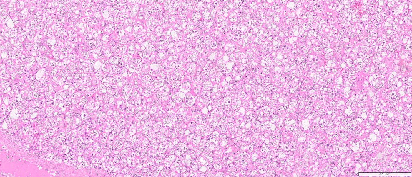 Eosinophilic vacuolated tumour: Low power: solid sheets of large eosinophilic cells with numerous vacuoles